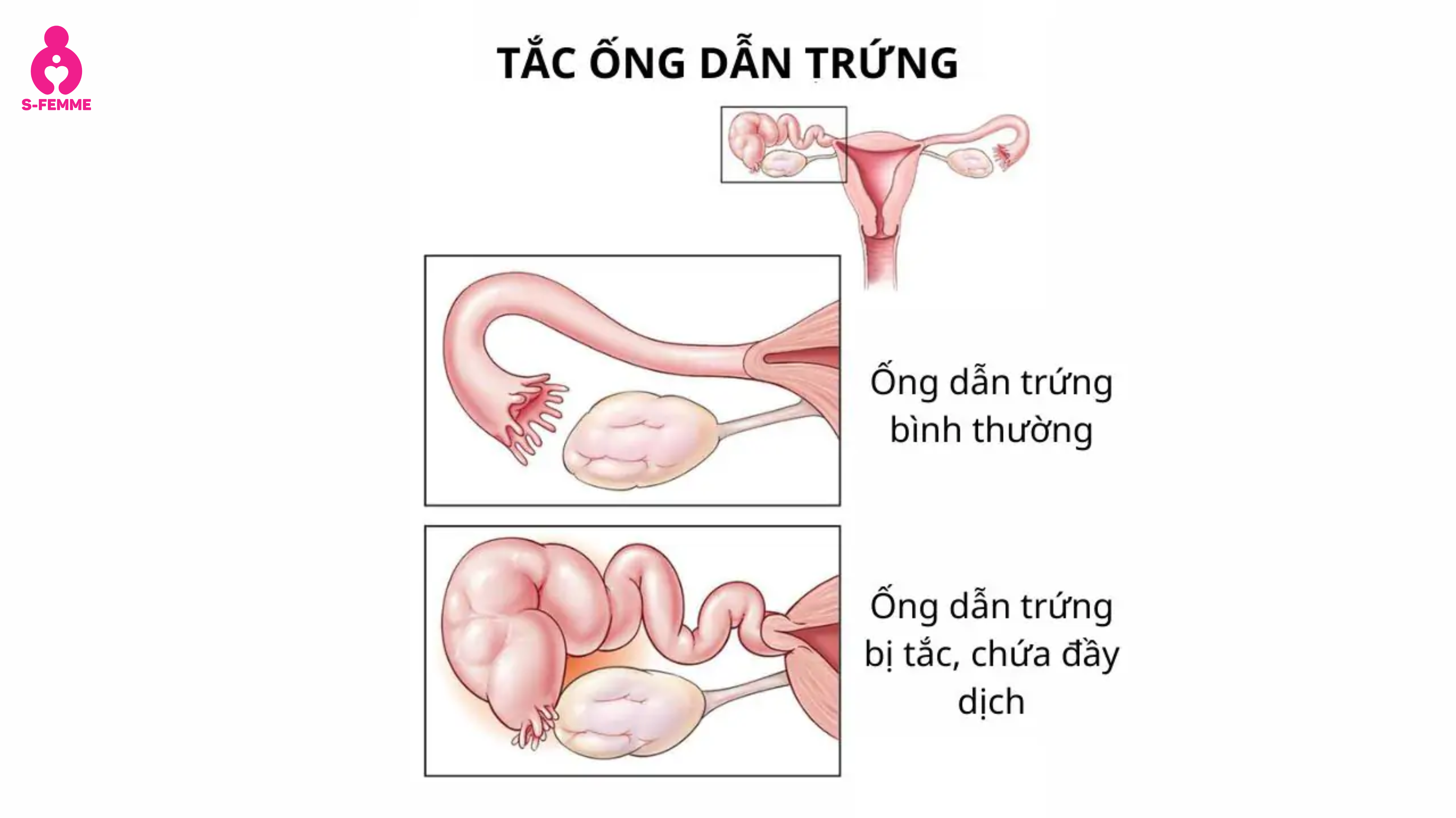 tắc vòi trứng là gì