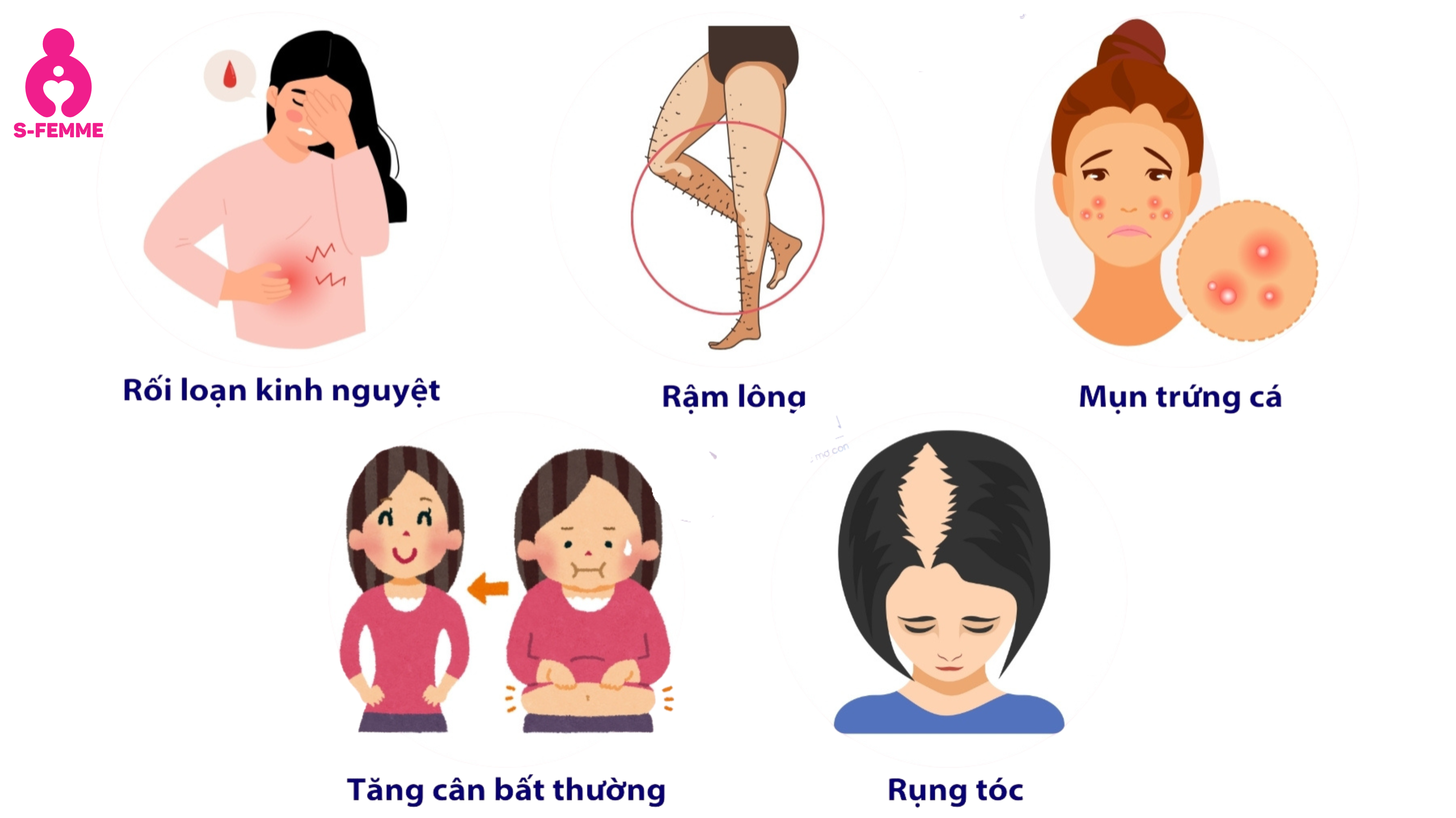 Triệu chứng thường gặp của đa nang buồng trứng