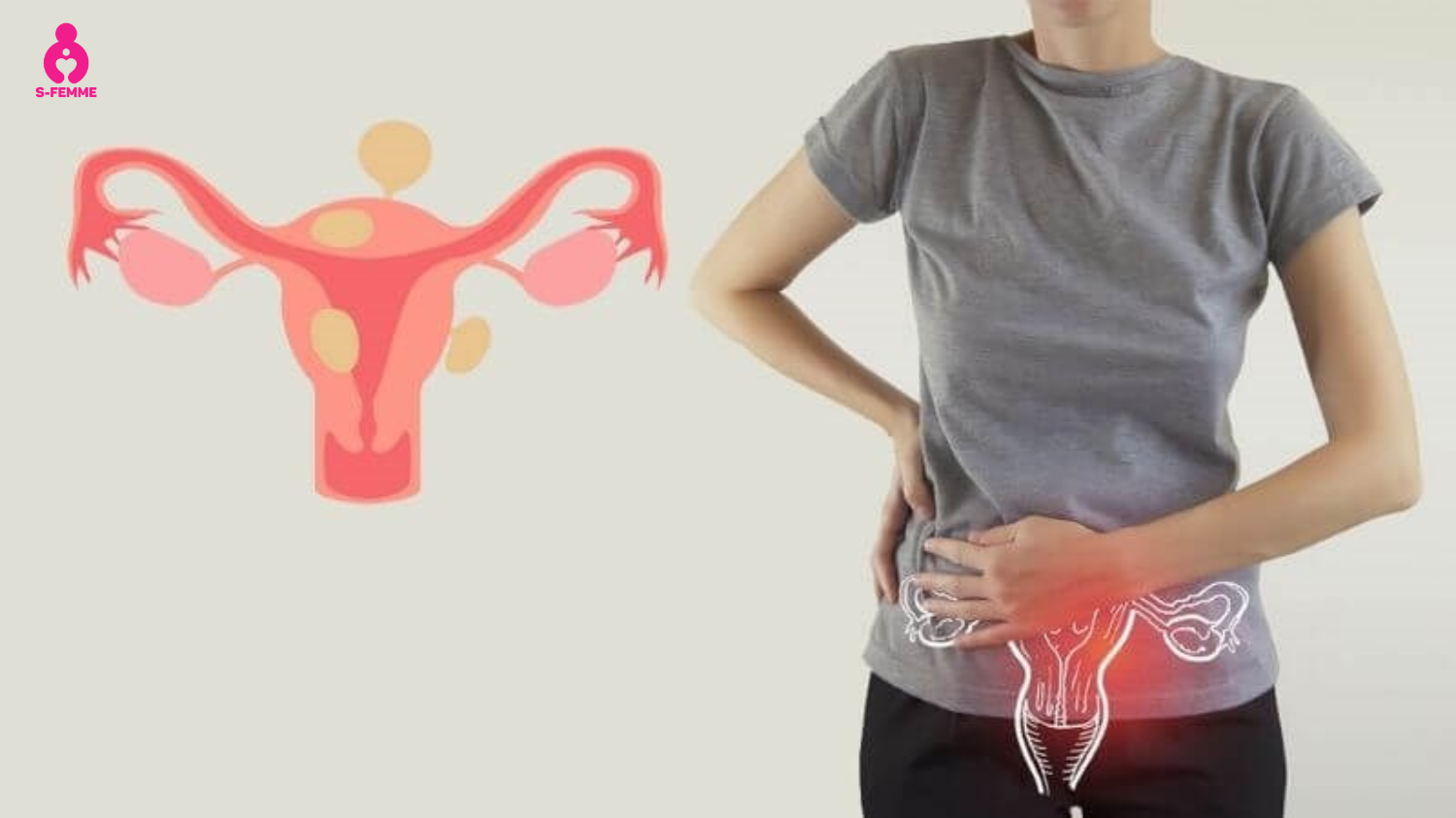 au bụng dưới ở phụ nữ là dấu hiệu của bệnh gì